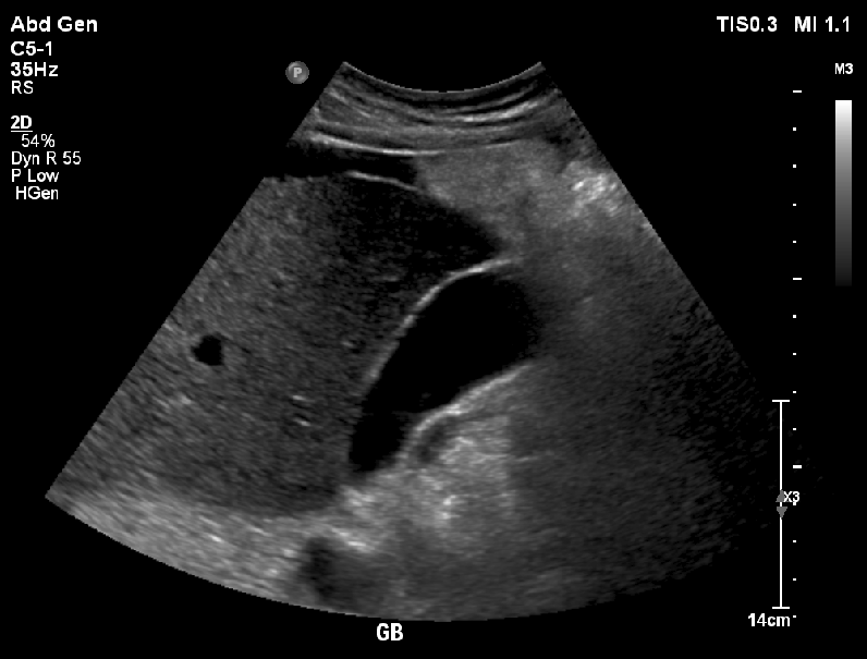 ecografia abdomen superior higado