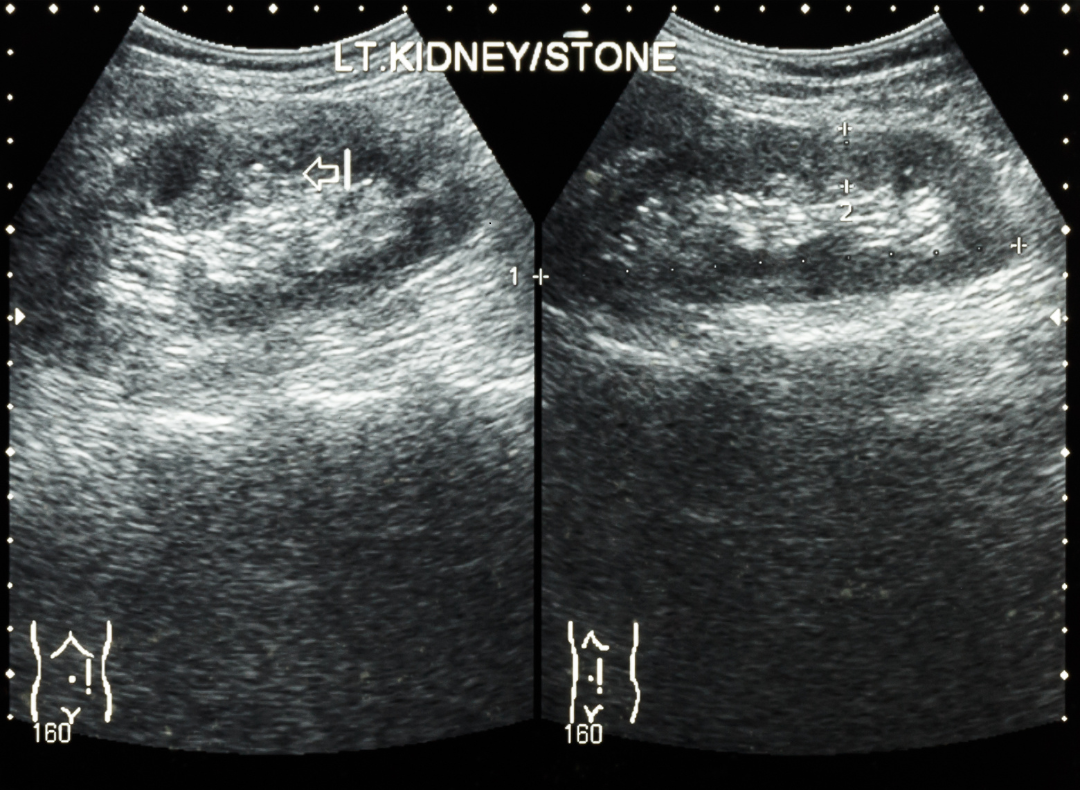 ecografia renal
