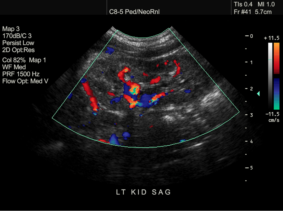 ecografia doppler renal