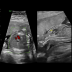 ecocardio ecocardiografia fetal corazon doppler