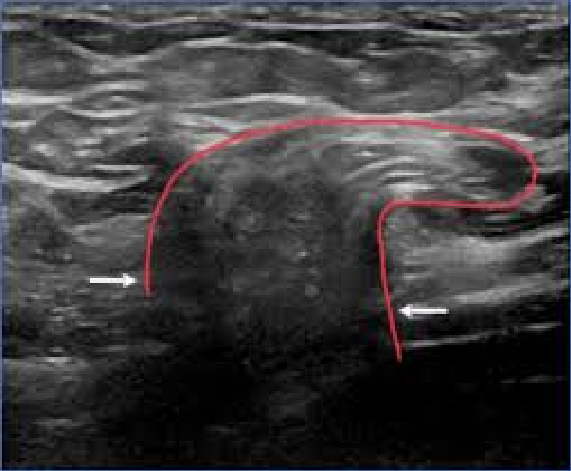 ecografia hernia inguinal umbilical