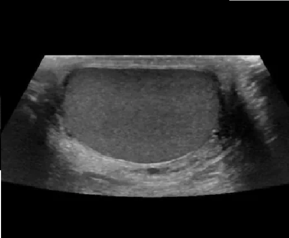 ecografia testicular escroto