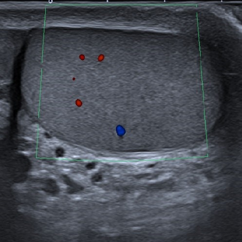 ecografia doppler testiculo