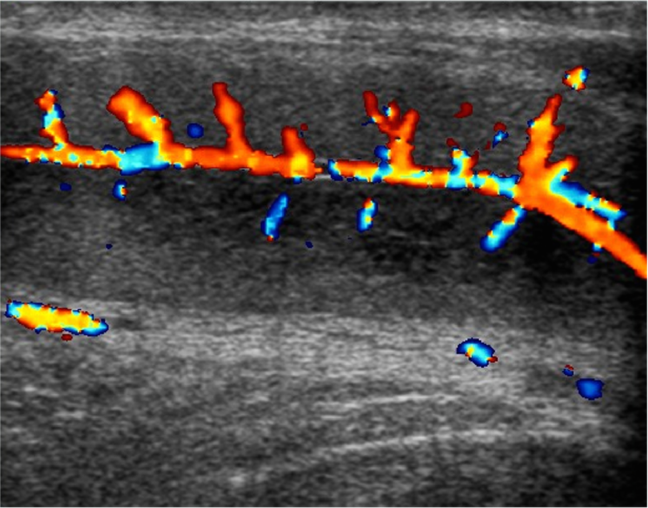 ecografia doppler de pene