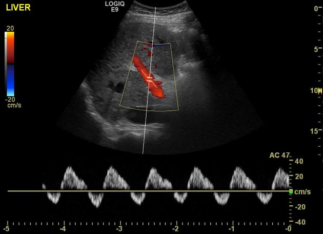 ecografia doppler hepatico portal