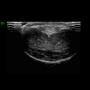 ecografia prostatica doppler de pene