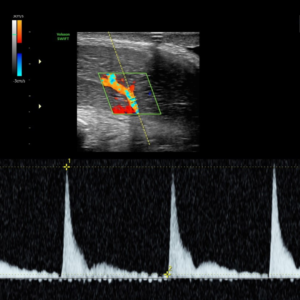 ecografia doppler pene