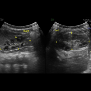 ecografia renal