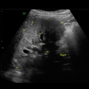 ecografia renal