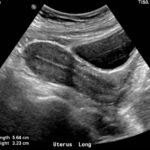 ecografia pelvica utero